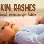Baby skin rash