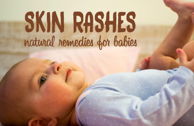 Baby skin rash