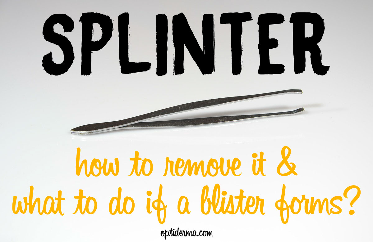 What Happens if You Don't Remove a Splinter? All about Splinters and Blisters
