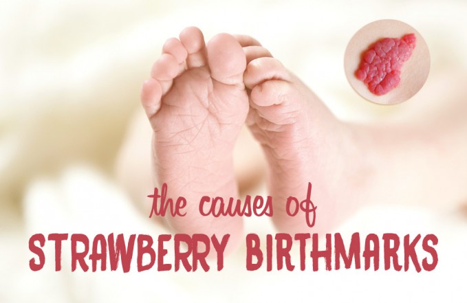 strawberry birthmarks infant