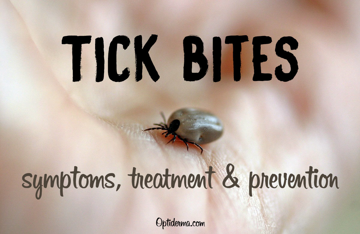 does tick bite itch
