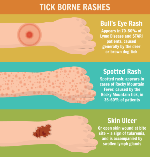 Tick borne rashes