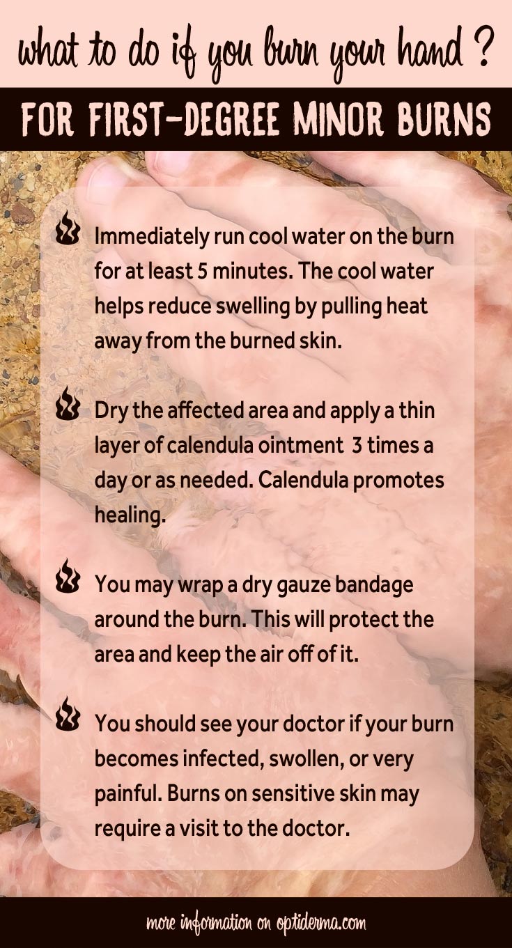 What to Do if You Burn your Hand?